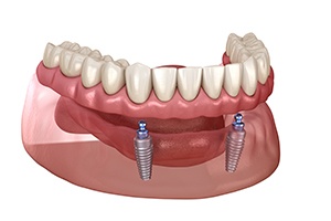 Illustration of ball-retained implant denture 