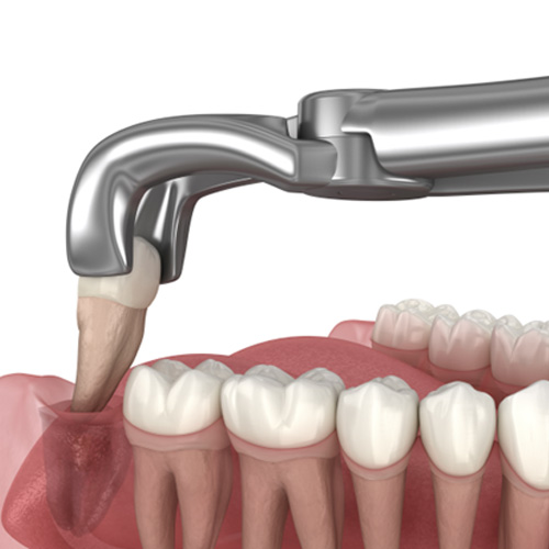 Illustration of a tooth being removed