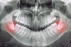 Wisdom tooth X-ray