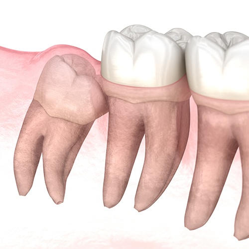Animated smile with an impacted wisdom tooth before extraction